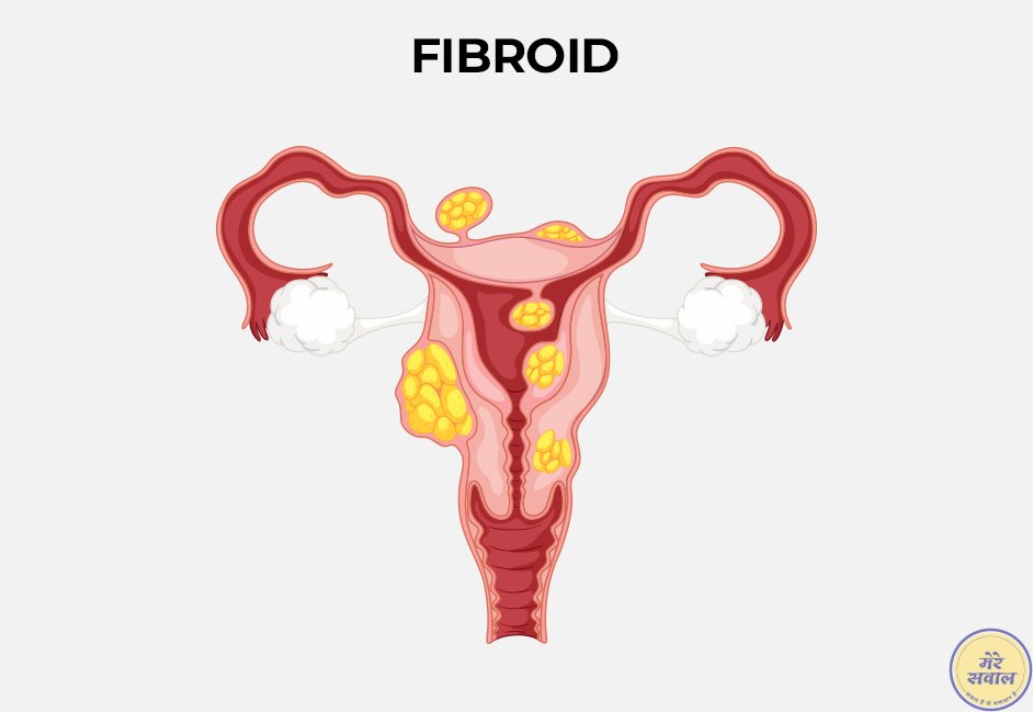 Fibroid