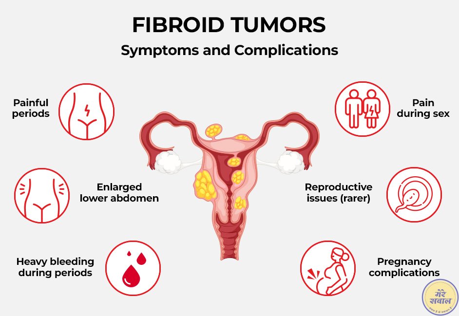 Symptoms of Uterine Fibroids