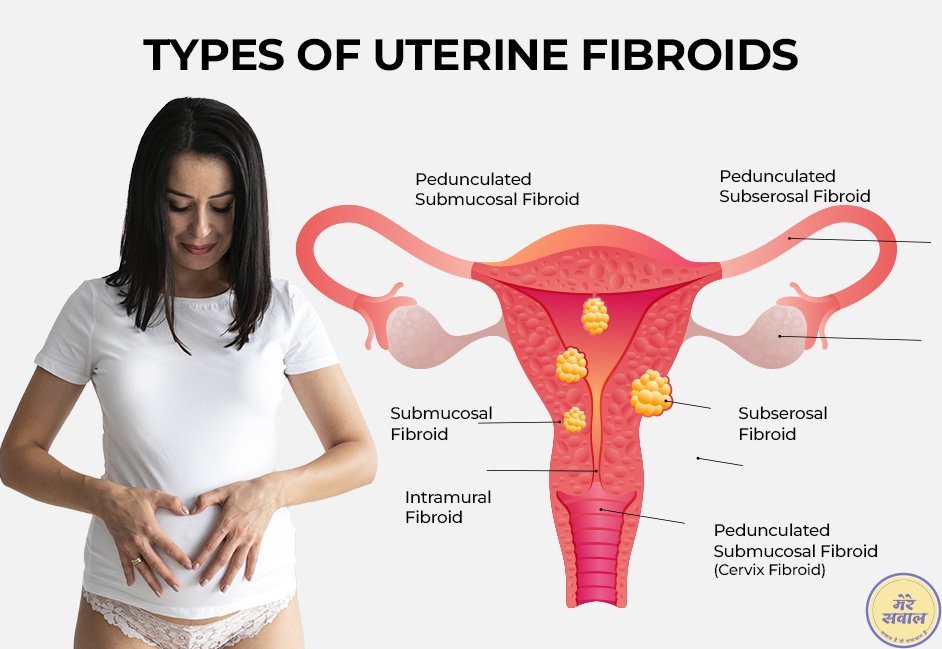 Types of Uterine Fibroid 3