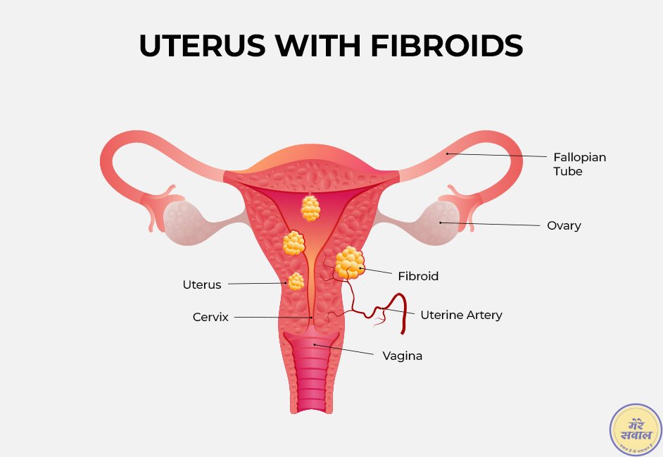 Uterine Fibroid 1