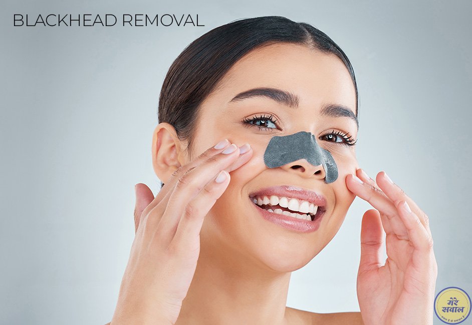 Blackhead-removal