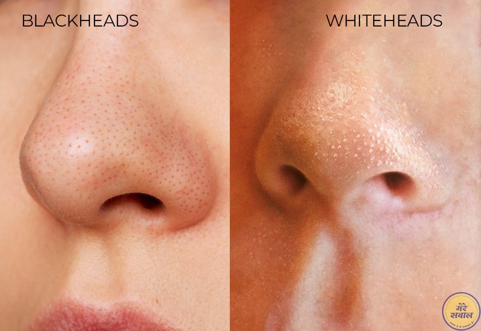 Blackheads Whiteheads