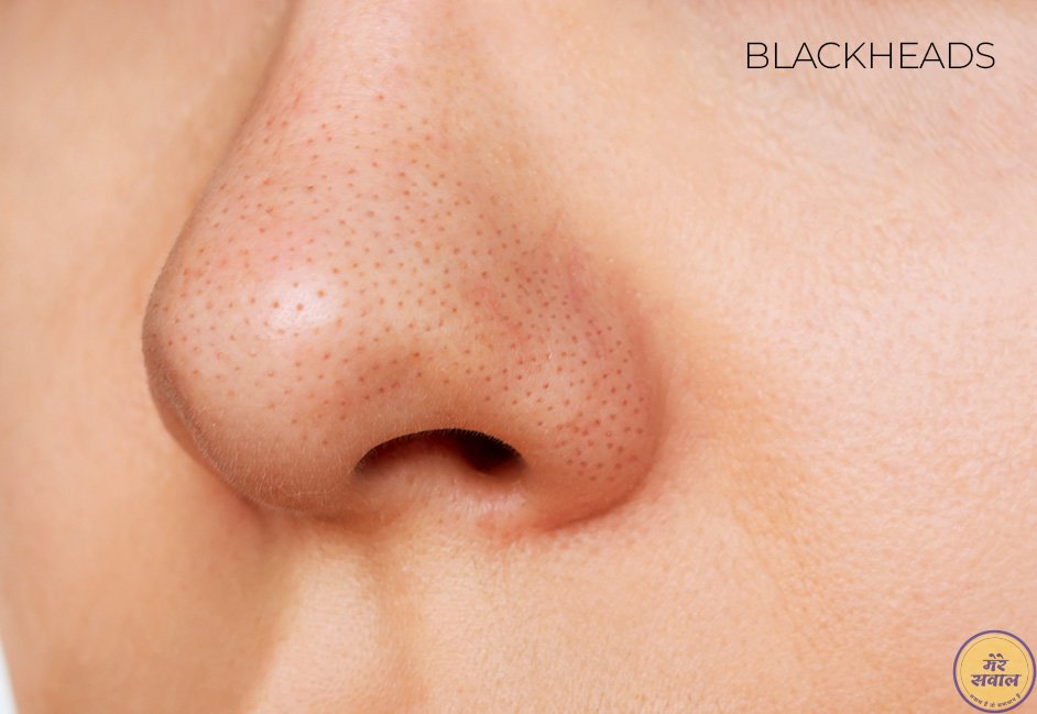 Blackheads