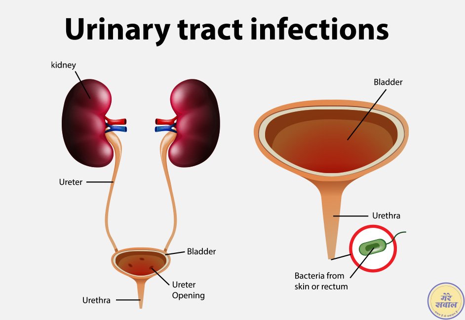 Urinary-Tract-Infection