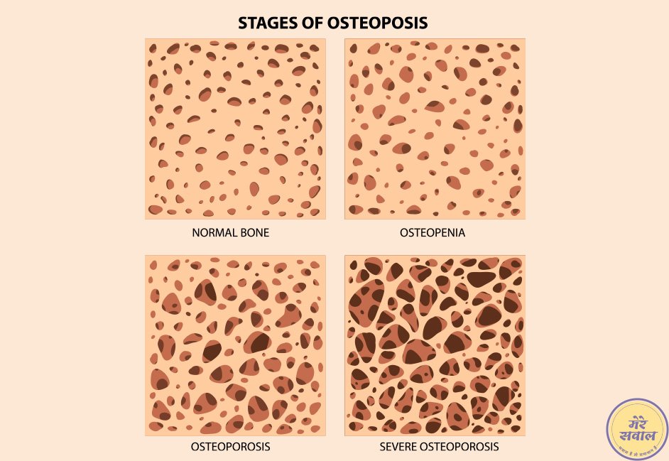 Stages-of-osteoporosis